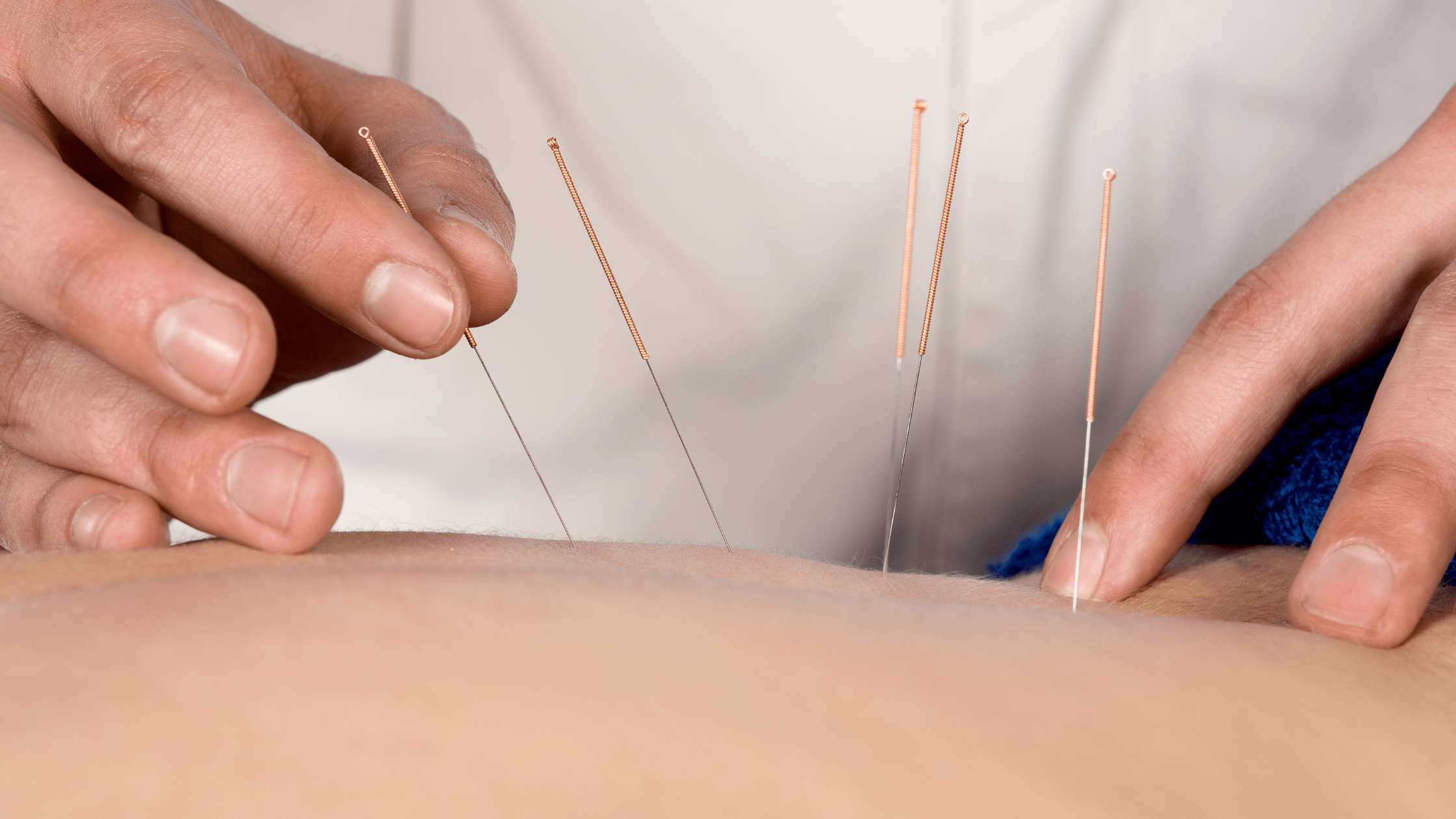 Acupuncture